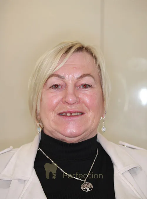 Dental implant patient before treatment