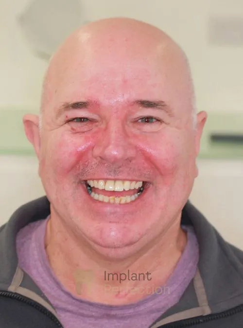 Dental implant patient after treatment