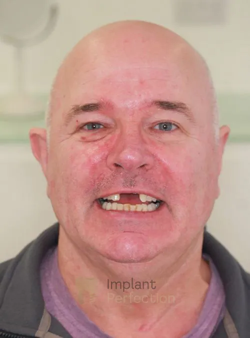 Dental implant patient before treatment