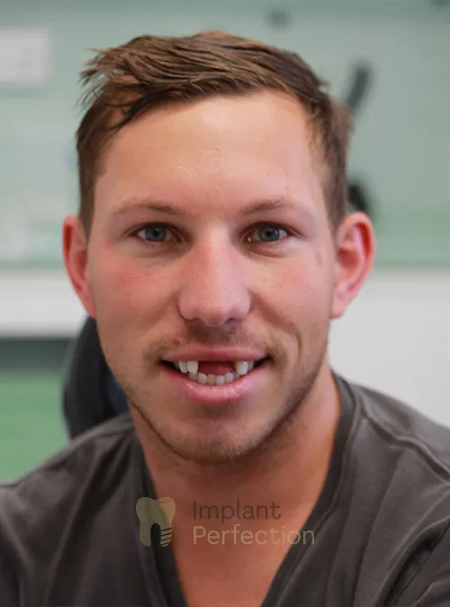 Dental implant patient before treatment