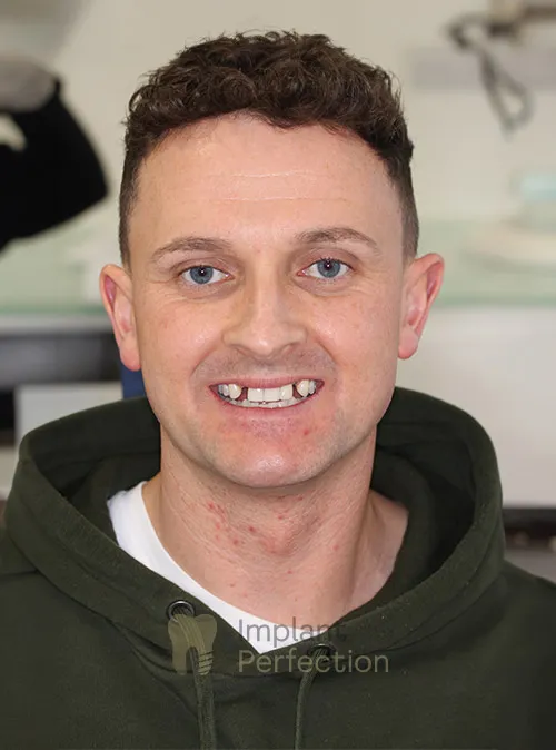 Dental implant patient before treatment