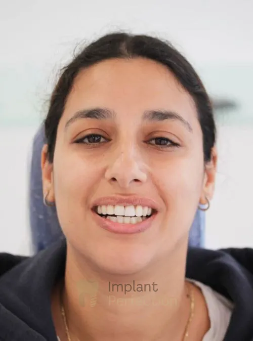 Dental implant patient after treatment