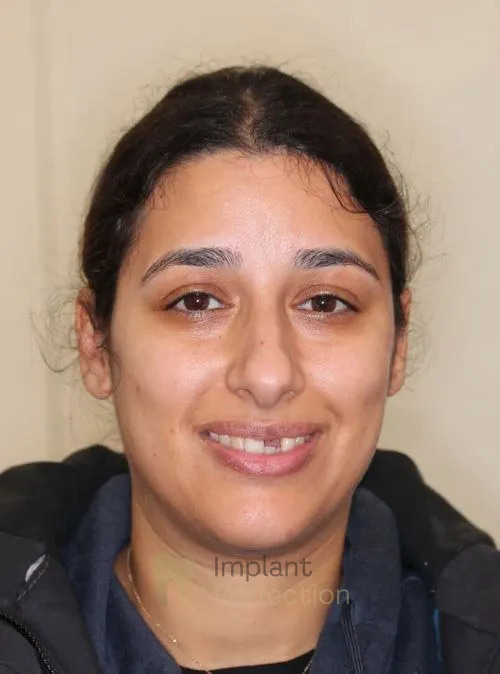 Dental implant patient before treatment