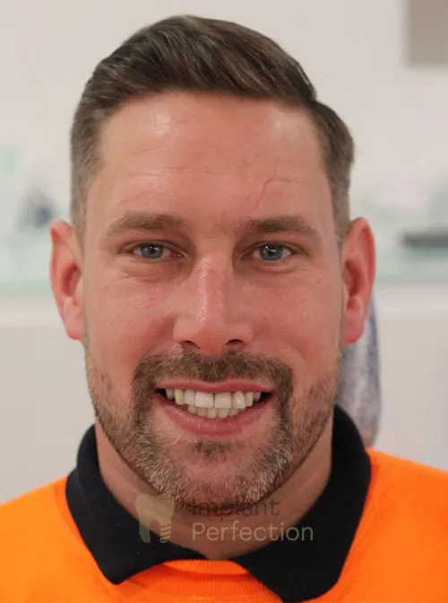 Dental implant patient after treatment