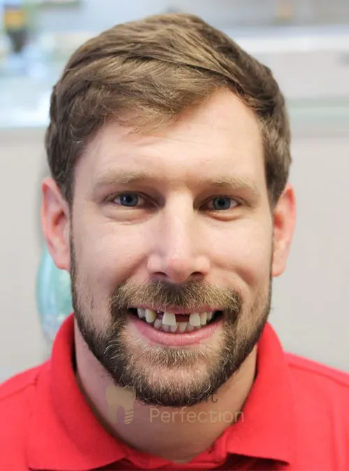 Dental implant patient before treatment