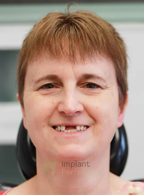 Dental implant patient before treatment