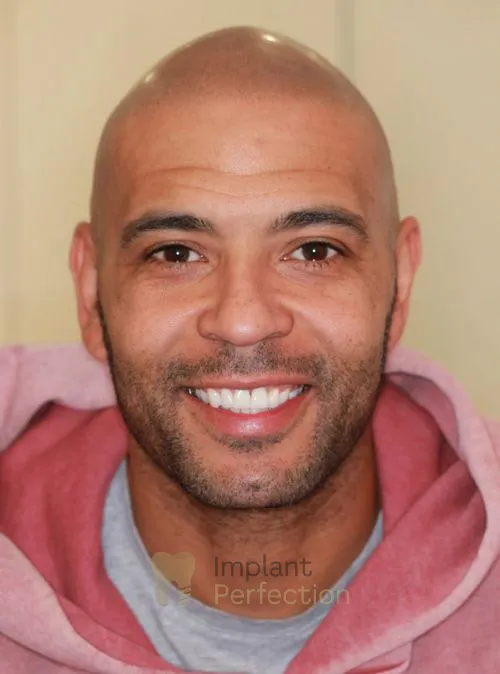 Dental implant patient after treatment