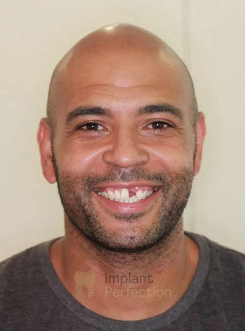 Dental implant patient before treatment